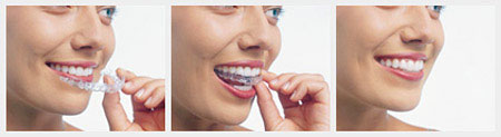 Invisalign - A clear alternative available at Max Buchwald DDS!