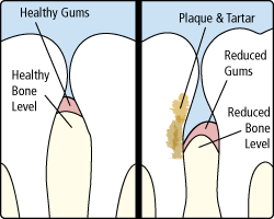 Periodontitis Treatment